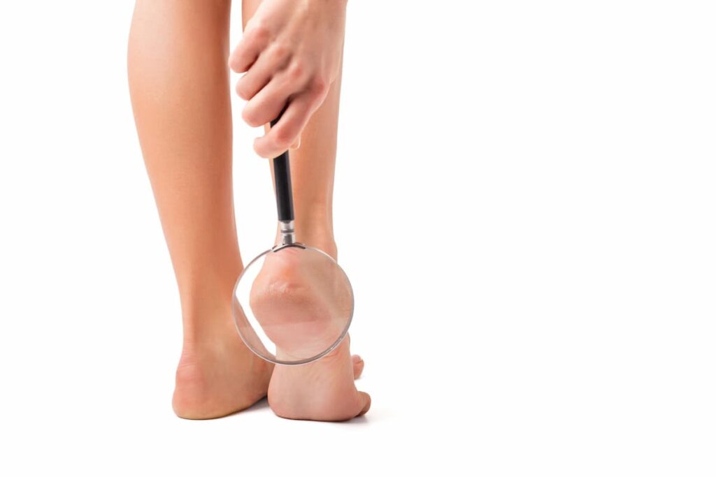 آیا خار پاشنه خطرناک است؟