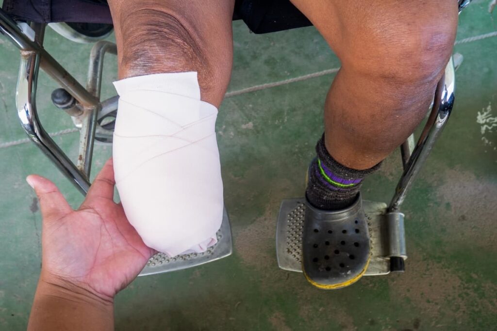 مراقبت‌های مورد نیاز قطع عضو