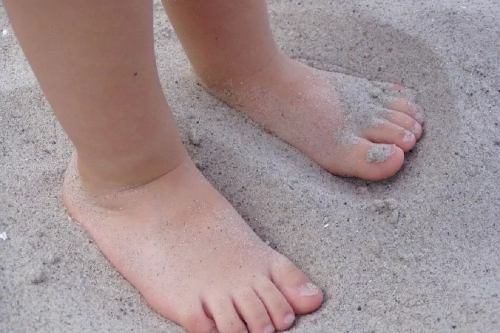 عوارض عدم درمان صافی کف پا در نوجوانان